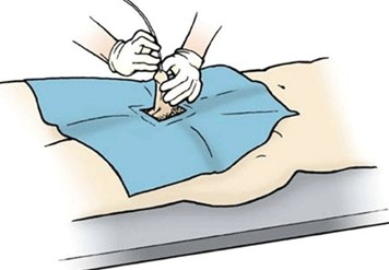 Ayurvedic approach to urethral stricture and local therapy context